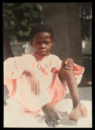 Victim of leprosy.