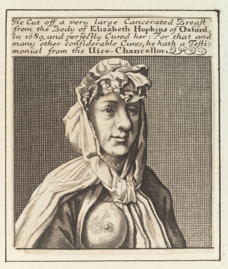 Elizabeth Hopkins of Oxford, showing a breast with cancer which was removed by Sir William Read. Engraving by M. Burghers, ca. 1700., [1700?], by Michael Burghers