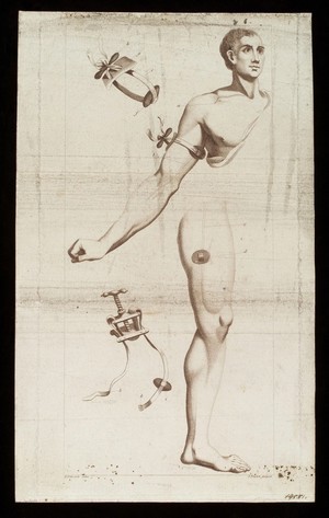 view Tourniquets: strap-operated and screw-operated, for the arm and thigh. Engraving by J. Newton after E. Edwards, 1783.