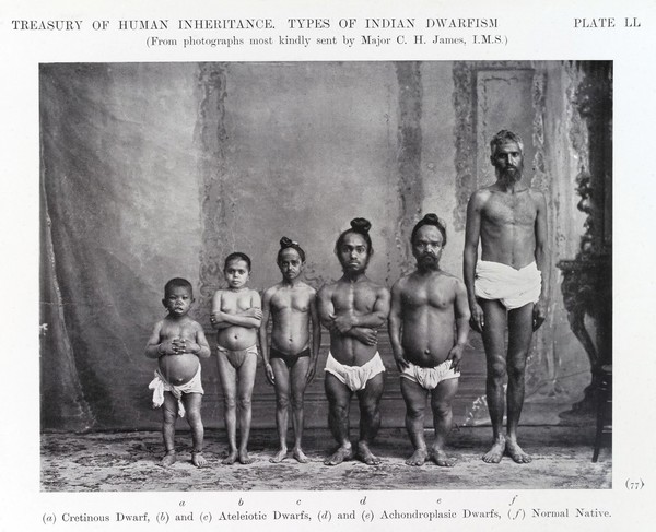 Types of "Indian Dwarfism". front view