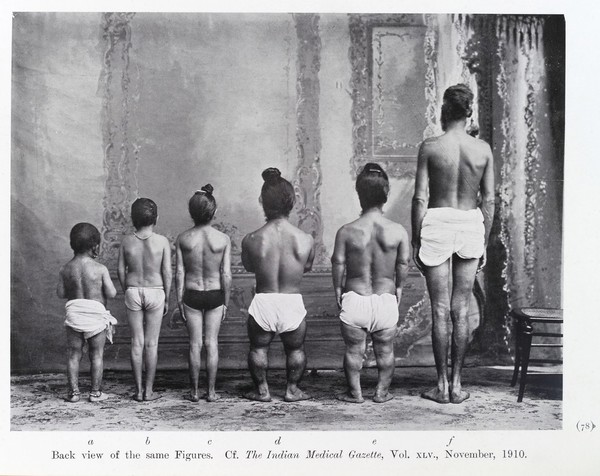 Types of "Indian Dwarfism". back view