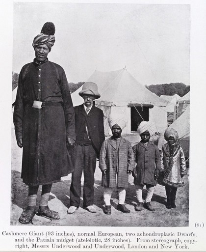 Types of "Indian Dwarfism"- giants and dwarfs, ascending line