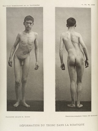 A young man with body deformed through sciatica