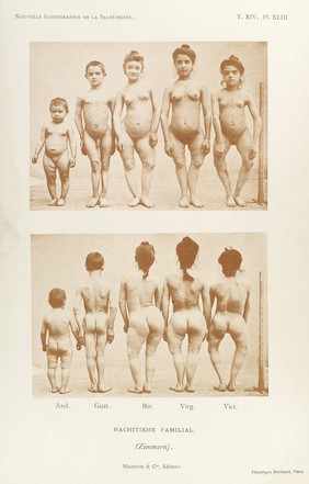 Adolescent male and female children with rickets, bearing the caption 'Rachitisme Familial'. Front and back views.