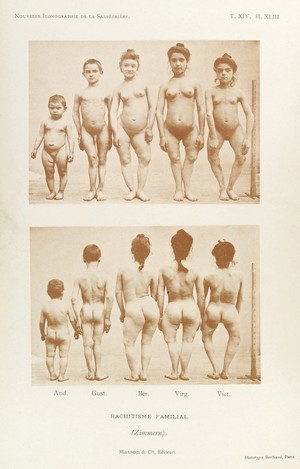 view Adolescent male and female children with rickets, bearing the caption 'Rachitisme Familial'. Front and back views.