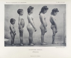 view Adolescent male and female children with rickets- side view.