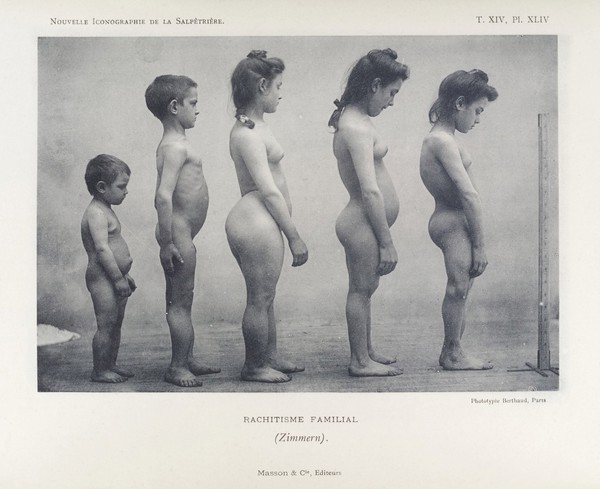 Adolescent male and female children with rickets- side view.