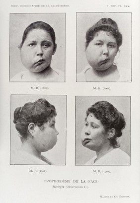 A woman with a deformed and swollen face, possibly Trophomeurosis (?). Caption: 'Trophoedeme de la Face'