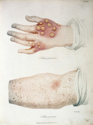 view Scabies porcina; from Delineations of Cutaneous... 1817