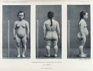view Photo of young woman with aprtial atypical Achondroplasia