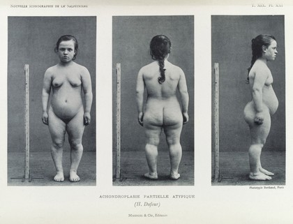 Photo of young woman with aprtial atypical Achondroplasia