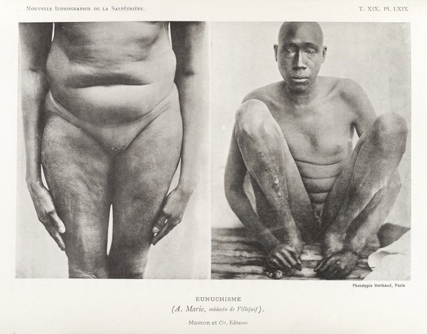 Photos of man suffering from condition called 'Eunuchism'