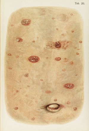 view Illustration of navel diseased with Syphilis