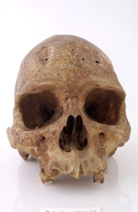 A human skull showing signs of Trepanning.