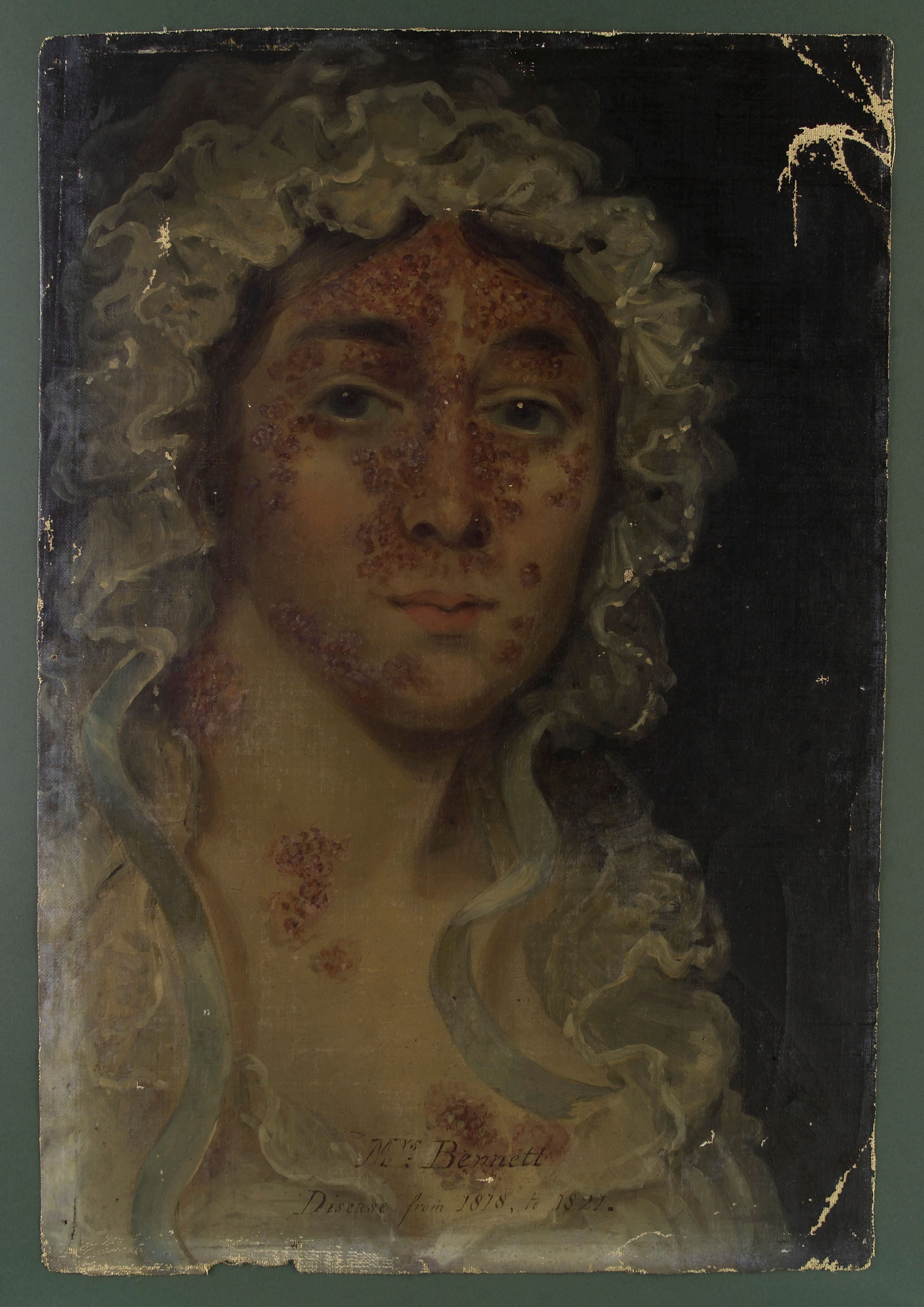 Mrs Bennett, afflicted with a skin disease. Oil painting, 1818/1821.