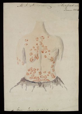 John Nevins, suffering from "herpes", skin disease on the back, possibly shingles. Watercolour, 1834.