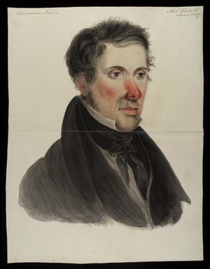 view Mr Gledell, suffering from a rodent disease which has consumed his left nostril. Watercolour, 1829.