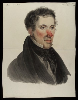 Mr Gledell, suffering from a rodent disease which has consumed his left nostril. Watercolour, 1829.