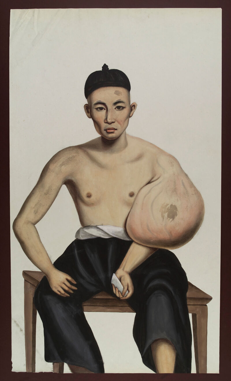 A man (Po Ashing) with a tumour on his left arm. Gouache, 18--, after Lam Qua, 1836., [after 1836], by Lam Qua