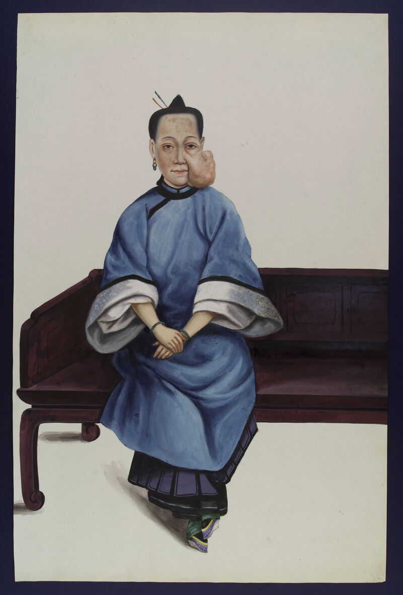 A woman (Lo Wanshun) with a tumour on her left cheek. Gouache, 18--, after Lam Qua, 1836., [after 1836], by Lam Qua
