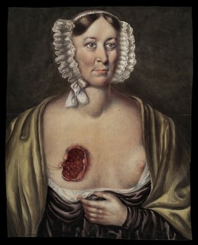 Mrs Prince, after surgical removal of a breast. Watercolour, 1841.