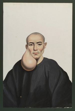 view A man with a pendent tumour below his right ear. Gouache, 18--, after Lam Qua, 1830/1850.