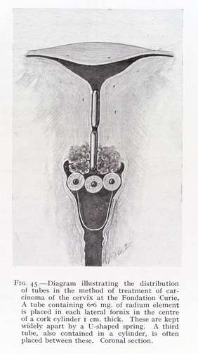 Radium therapy : principles and practice / by G.E. Birkett.