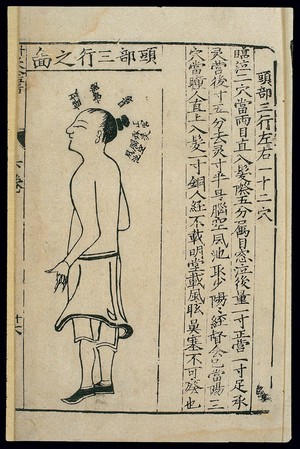 view Acupuncture chart, third head line, Chinese woodcut