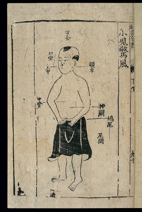 Paediatric acu-moxa: infantile convulsions, Chinese woodcut