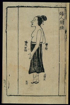 Gynaecological acu-moxa: amenorrhoea, Chinese woodcut