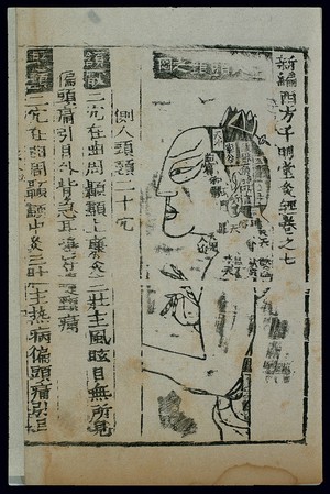 view Acu-moxa chart, side of head and neck, Chinese woodcut