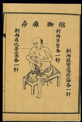 Treatment of acute pathologies, suojiao yongsha, lithograph