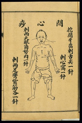 Acute pathologies, thoracic oppression, Chinese lithograph