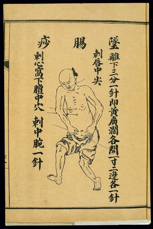 view Acute pathologies, intestinal prolapse, Chinese lithograph