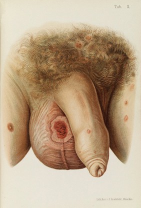 Coloured illustration of scrotum diseased with Syphilis.