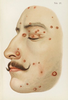 Coloured illustration of the profile of the face diseased with Syphilis.