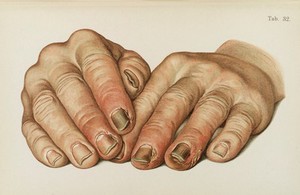 view Illustration of hands diseased with Syphilis