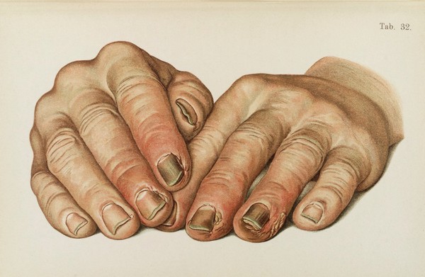 Illustration of hands diseased with Syphilis