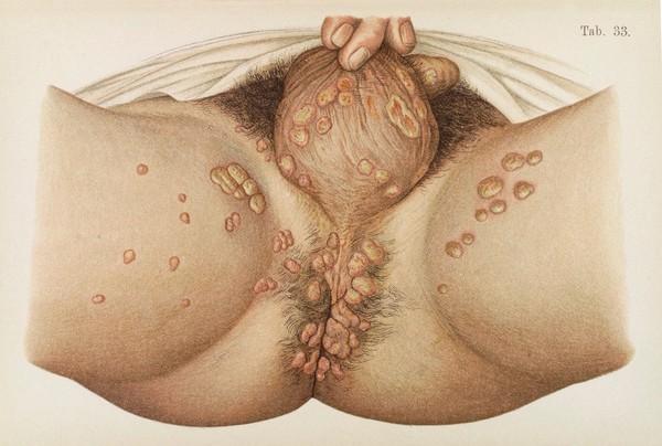 Illustrative plate showing skin of the scrotum and perineum area diseased with Syphilis.