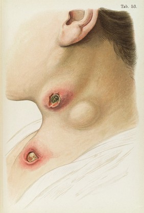 Illustration of the neck diseased with Syphilis