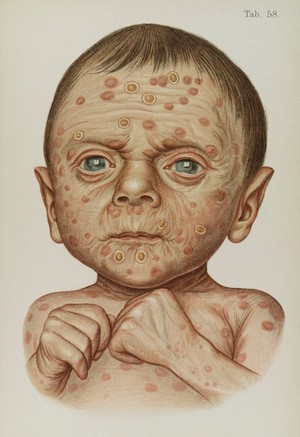 view Illustration of baby diseased with hereditary Syphilis