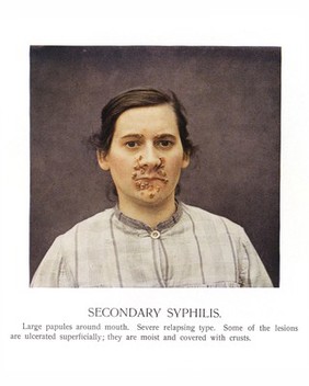 Atlas of syphilis / by Leo v. Zumbusch.