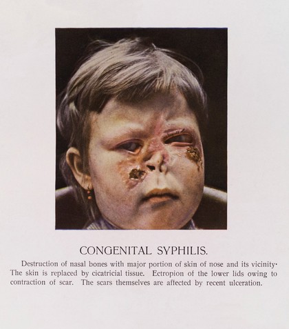 Atlas of syphilis / by Leo v. Zumbusch.