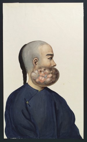 view A man (Leang Ashing), in profile, with a tumour on the right side of his face. Gouache, 18--, after Lam Qua, 1837.