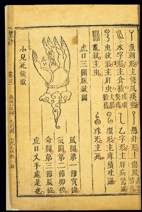 Paediatric finger diagnosis: 'Three Passes', Chinese woodcut