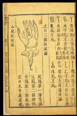 view Paediatric finger diagnosis: 'Three Passes', Chinese woodcut