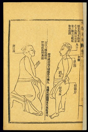 Chinese woodcut: Abscesses -- fugu and duikou abscess