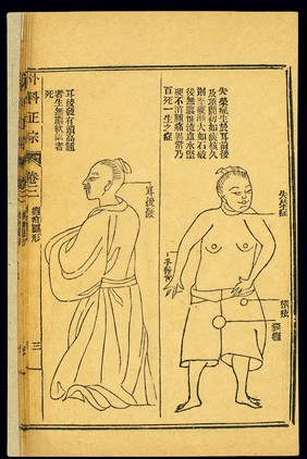 Chinese woodcut: Abscesses -- postauricular abscesses, etc.