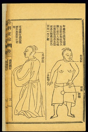 view Chinese woodcut: Abscesses -- postauricular abscesses, etc.