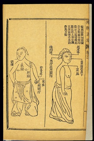 view Chinese woodcut: Abscesses -- fengmei and qinnao abscesses